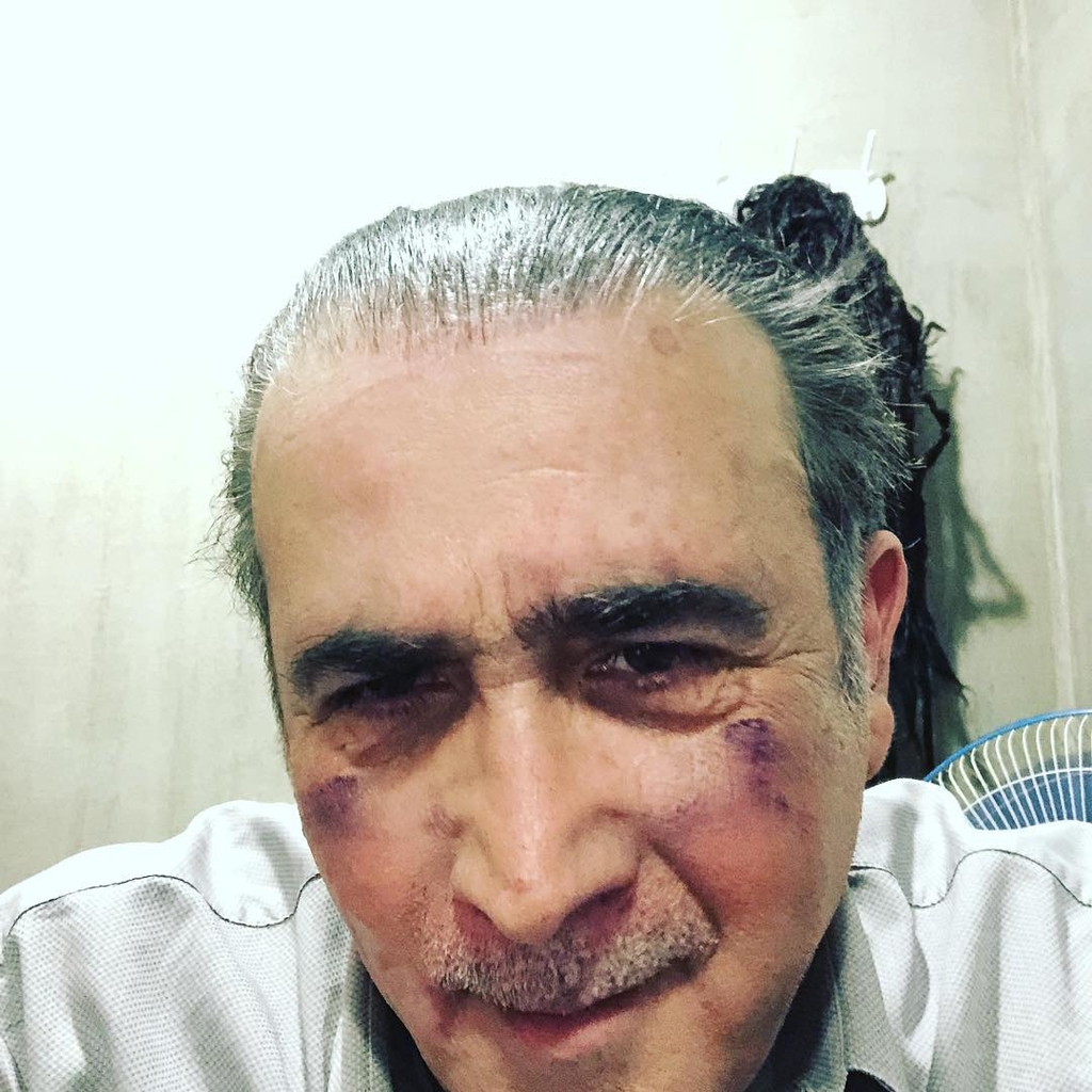 Με μώλωπες στο πρόσωπο ο Λάκης Λαζόπουλος. Τι συνέβη στον ηθοποιό;