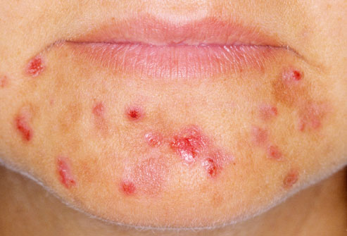 12dermnet rm photo of woman with severe acne