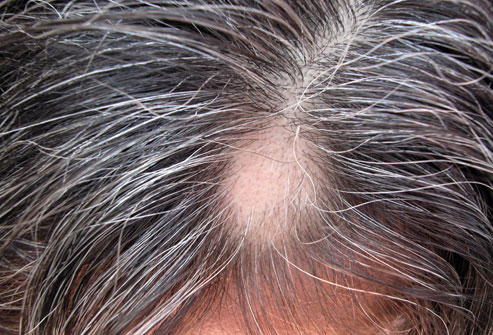 13photolibrary rf photo of alopecia areata