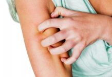 Αντιμετωπίστε τη φαγούρα από το τσίμπημα του κουνουπιού… αλλιώς!