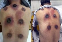 Η πλάτη του πρήστηκε και γέμισε τρύπες – Μόλις δείτε τι το προκάλεσε, θα ανατριχιάσετε!