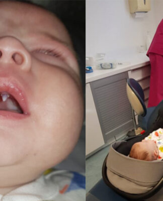 Γονείς και γιατροί σοκαρίστηκαν όταν αγόρι 11 εβδομάδων έβγαλε «δόντι βαμπίρ» σε ένα βράδυ