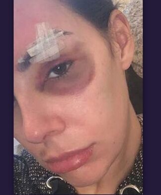 Θύμα ξυλοδαρμού γνωστή τηλεπερσόνα- Φωτογραφίες που σοκάρουν