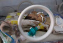 Διαχωρίζονται σιαμαία βρέφη – Έχουν μαζί 1 γεννητικό όργανο και 2 πόδια.