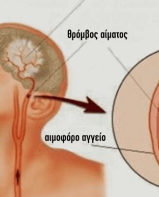Tι κάνουμε σε ένα εγκεφαλικό – Παίρνει μόνο ένα λεπτό για να το διαβάσετε