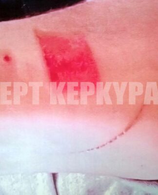 Κέρκυρα: Έζησε την κόλαση σε κουζίνα γνωστού εστιατορίου – Καταγγελία σπουδαστή μαγειρικής για «μεσαιωνικά» βασανιστήρια.