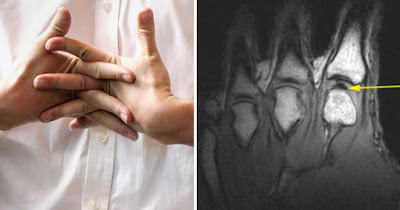 Κρακ στα δάχτυλα και στις αρθώσεις: Τι προκαλεί αυτόν τον ενοχλητικό θόρυβο – Πότε πρέπει να πάτε στο γιατρό - Εικόνα 3
