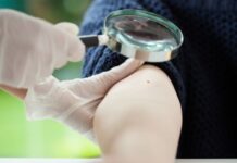 ΚΑΡΚΙΝΟΣ ΔΕΡΜΑΤΟΣ: Δείτε ποια είναι τα συμπτώματα