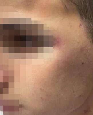 Ξυλοδαρμός στο Γαλάτσι: «Φοβάμαι τι άλλο θα μου συμβεί» – Όσα είπε το 17χρονο θύμα
